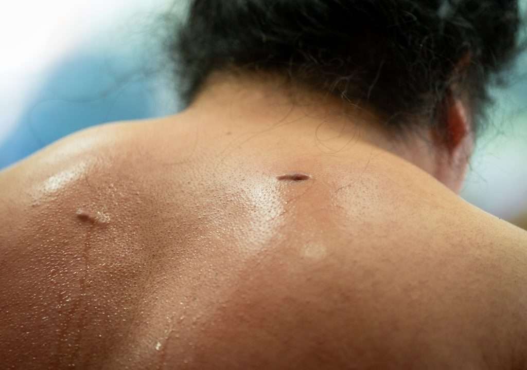 scars after breast implant removal