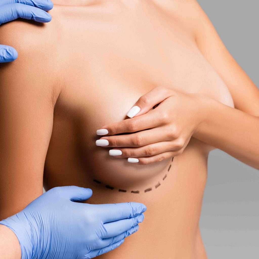 breast aug with lift consultation Newport Beach